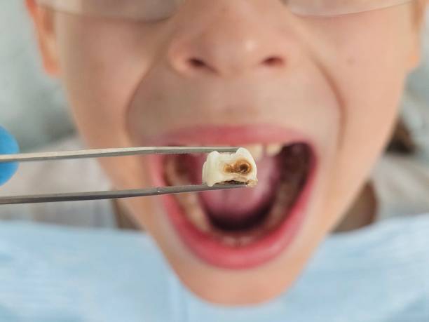 Best Emergency Tooth Extraction in Ferron, UT
