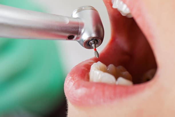 Best Emergency Tooth Extraction in Ferron, UT